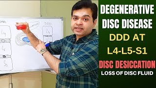 Degenerative Disc Disease DDD L4 L5 L5 S1Disc Desiccation Disc Degeneration Disease Treatment [upl. by Mommy587]