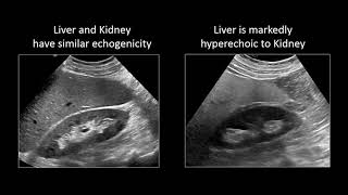 GI Imaging  Hepatic Steatosis and Cirrhosis [upl. by Ttennej319]