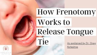 How Frenotomy Works to Release Tongue Tie [upl. by Deutsch]