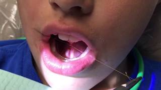 Functional frenuloplasty updated technique with lingual palatal suction [upl. by Brookes]