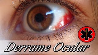 DERRAME OCULAR  Derrame en el Ojo 👁️  Sangre en el Ojo [upl. by Areval383]